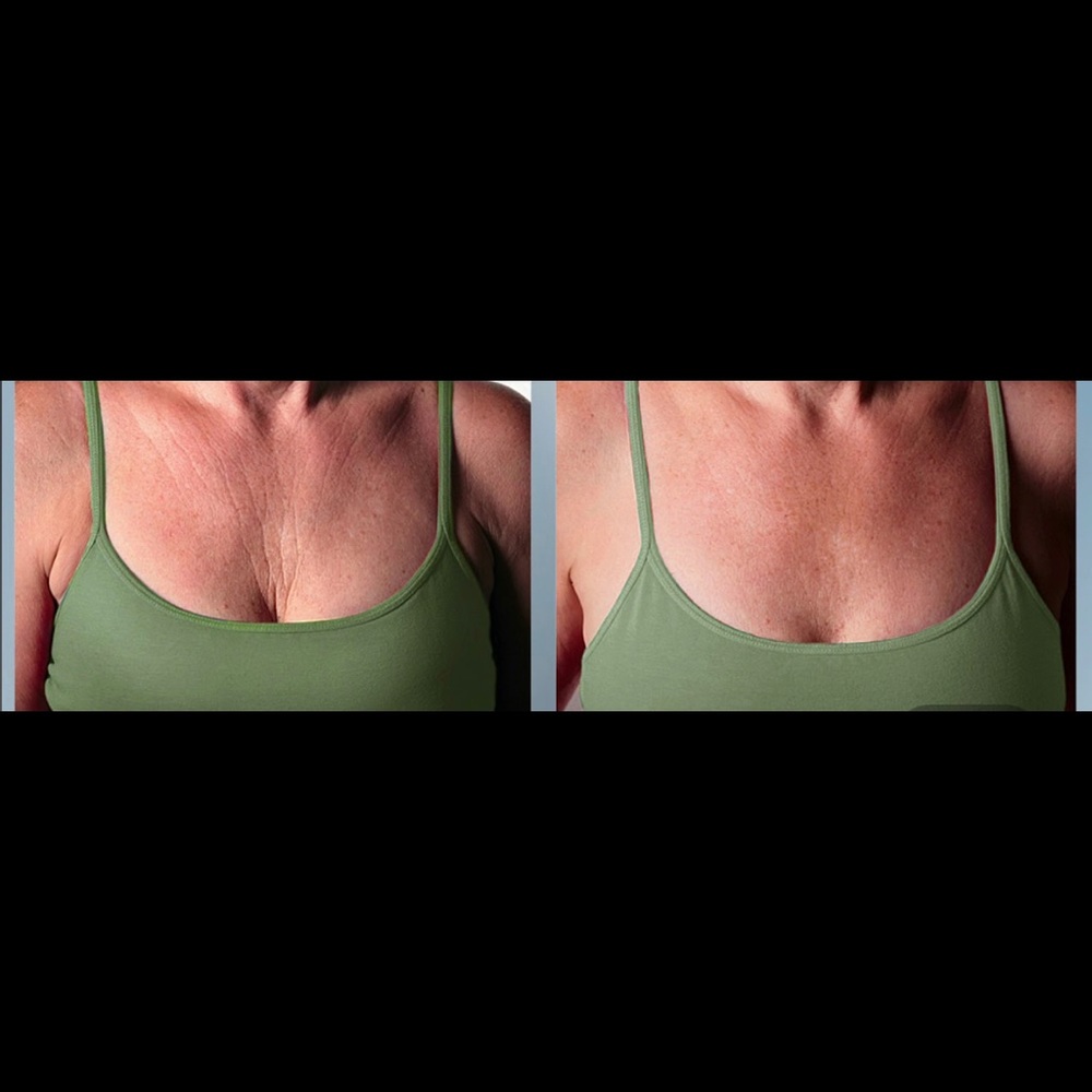 Chest wrinkle ease - Picture 5 of 6